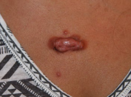 KRF Clinical Practice Guidelines in Keloid Disorder