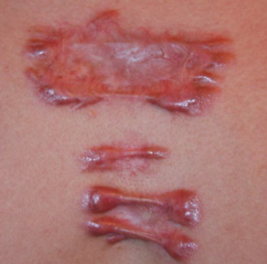 Treatment Strategy