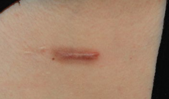 chest keloid