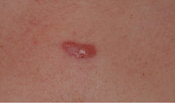 chest keloid