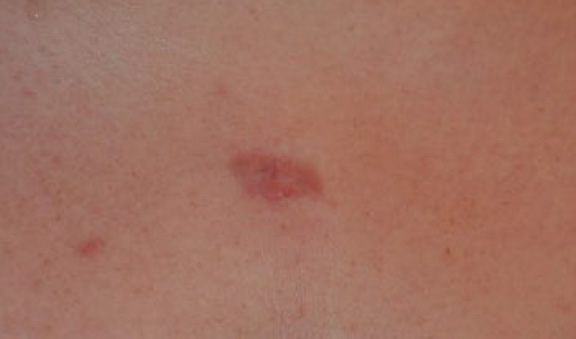 chest keloid