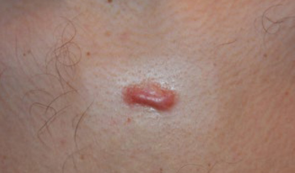 chest keloid