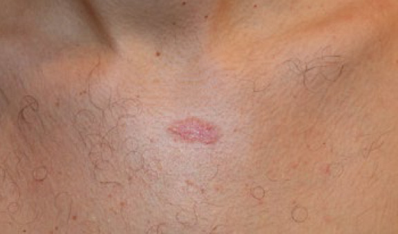 chest keloid