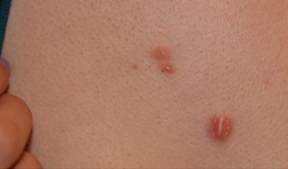 chest keloid