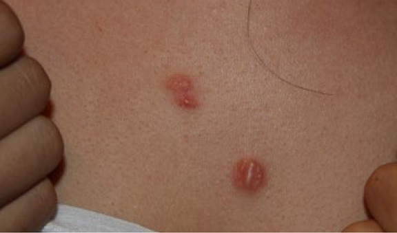 chest keloid