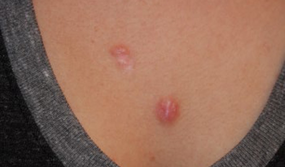 chest keloid