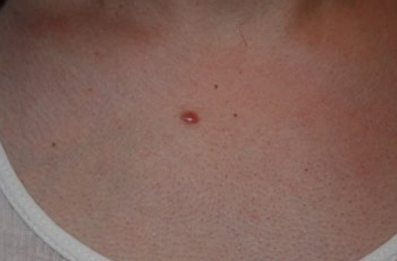 chest keloid