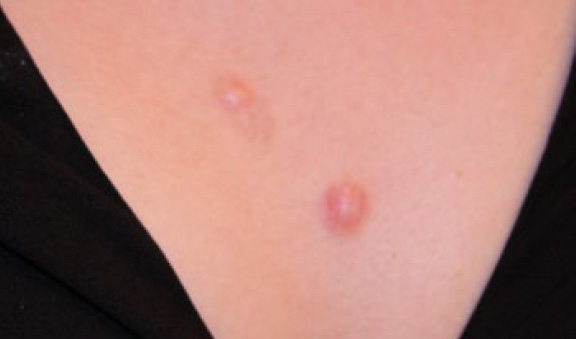 chest keloid