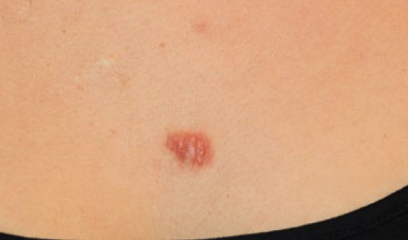 chest keloid