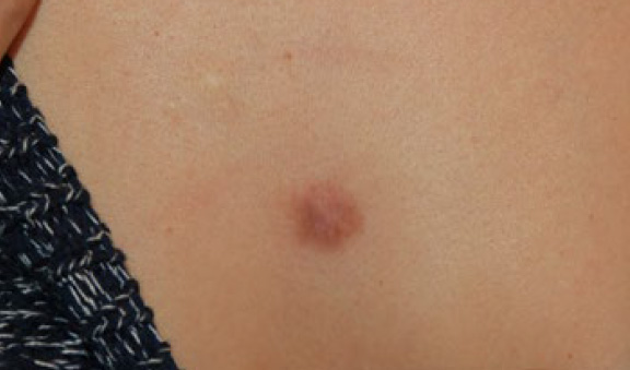 chest keloid