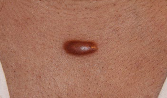 chest keloid