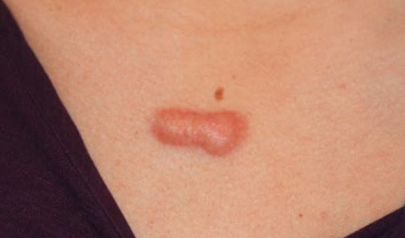 chest keloid