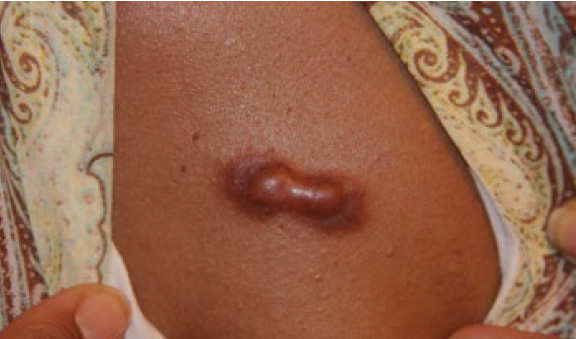 chest keloid