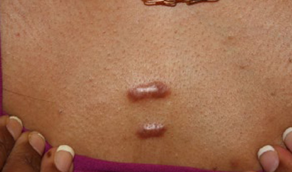 chest keloid