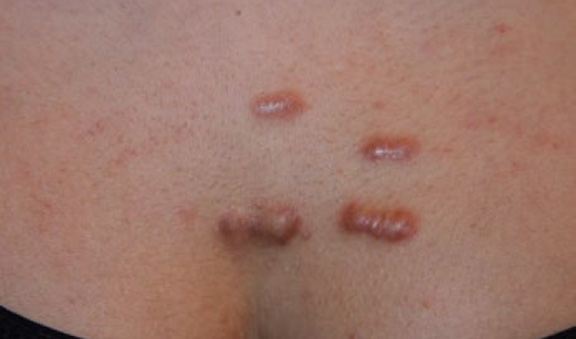 chest keloid