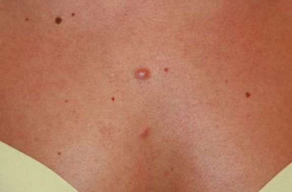 chest keloid