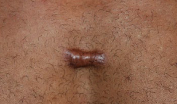 chest keloid