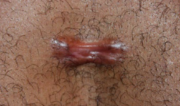 chest keloid