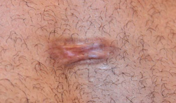 chest keloid