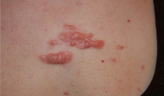 chest keloid