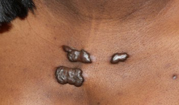 chest keloid