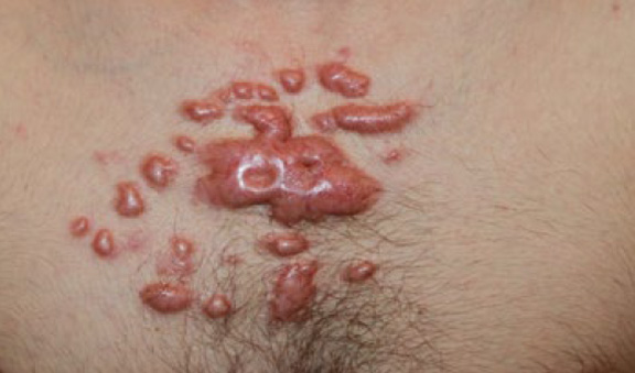 chest keloid