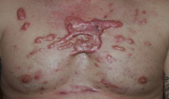 chest keloid