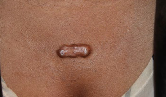 chest keloid