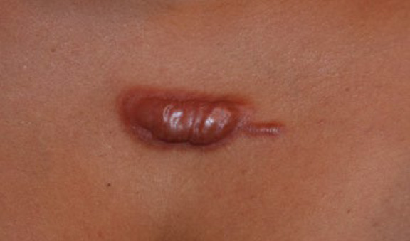 chest keloid