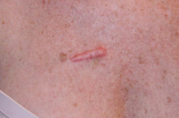 chest keloid