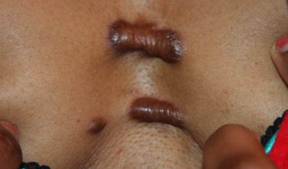 chest keloid