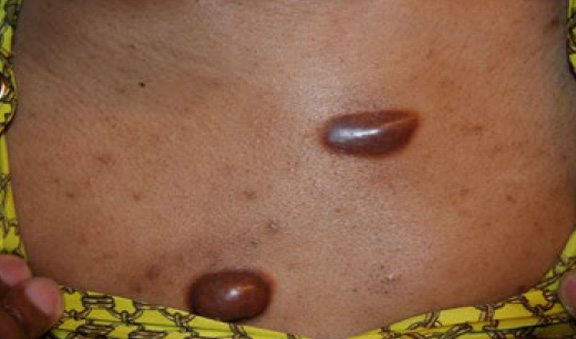 chest keloid