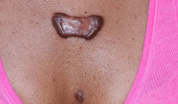 chest keloid