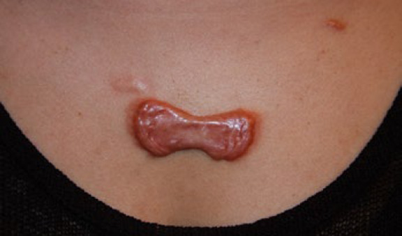 chest keloid