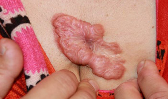 chest keloid