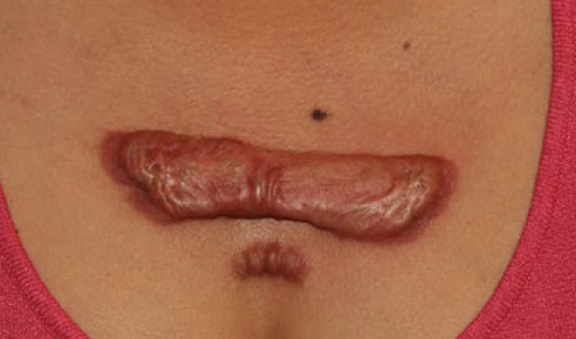 chest keloid