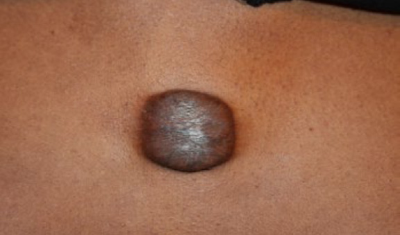 chest keloid