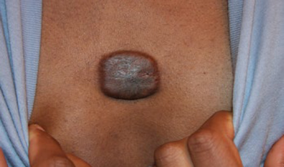 chest keloid