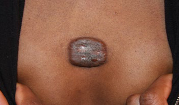 chest keloid