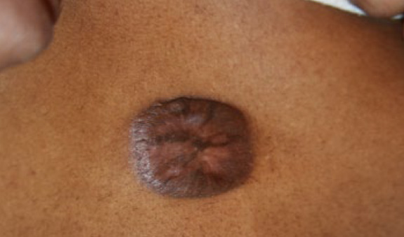 chest keloid