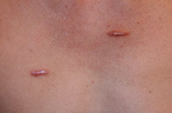 chest keloid