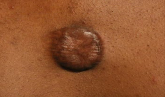 chest keloid