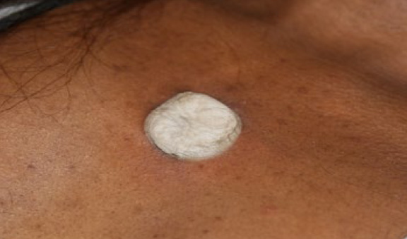 chest keloid