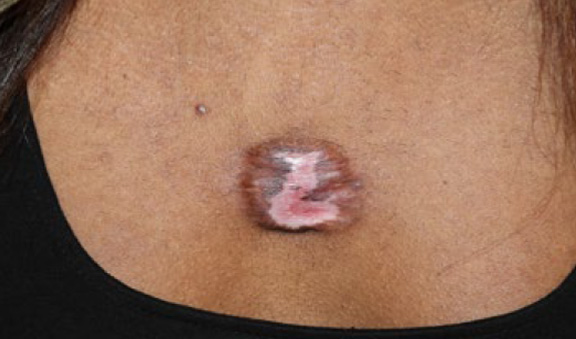 chest keloid