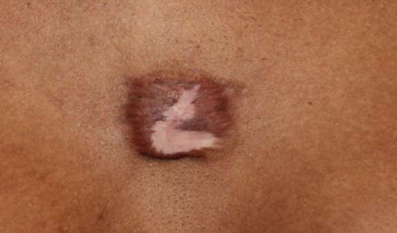 chest keloid