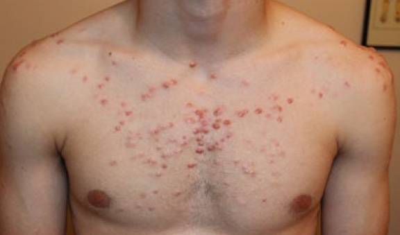 chest keloid