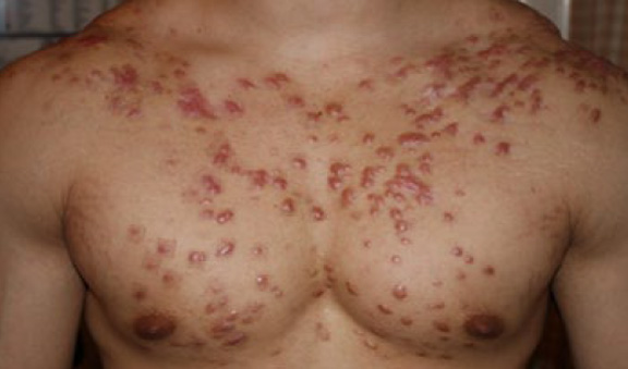 chest keloid