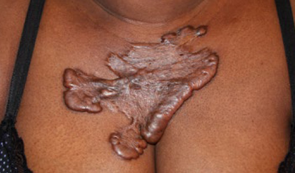 chest keloid