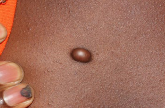 chest keloid