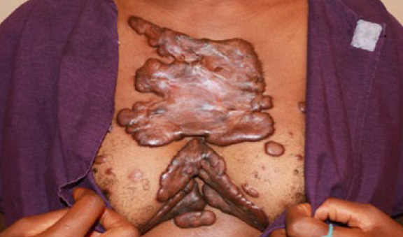 chest keloid